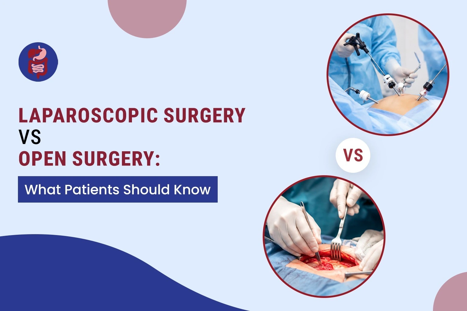 Comparison of laparoscopic surgery and open surgery showing key differences, benefits, recovery time, and surgical procedures by Dr. Lokesh Yadav.